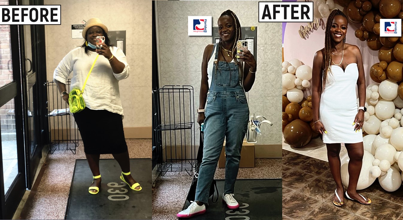 Weight loss surgery - before and after