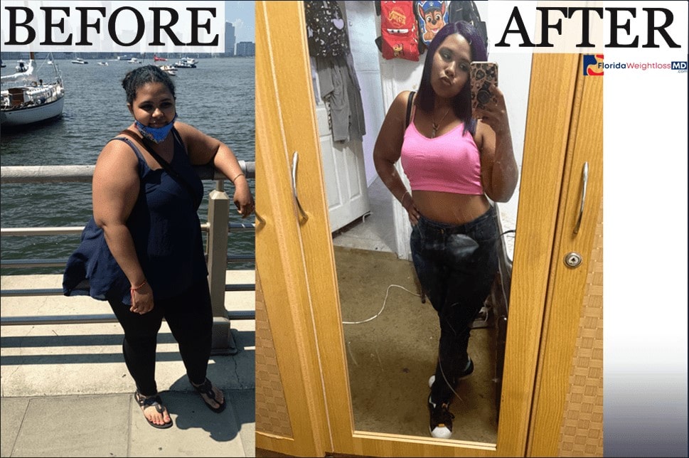 Weight loss surgery before and after patient result