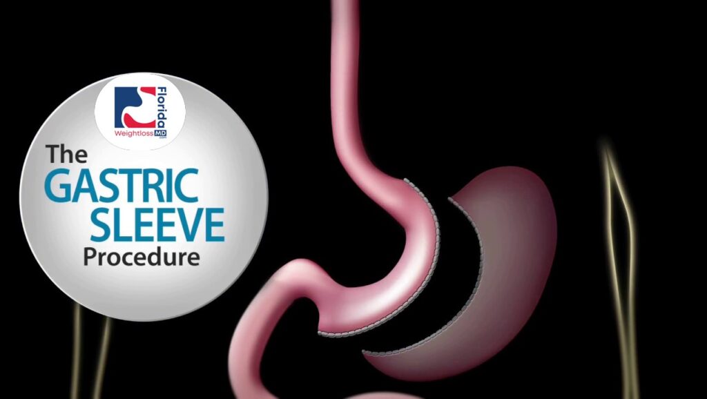 Best Gastric Sleeve doctors in Hollywood