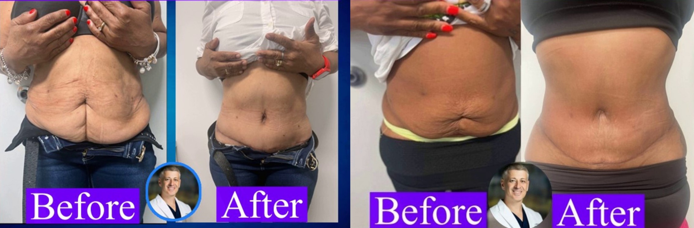 Panniculectomy - Before And After excess skin removal pictures with Dr. Sergey Terushkin