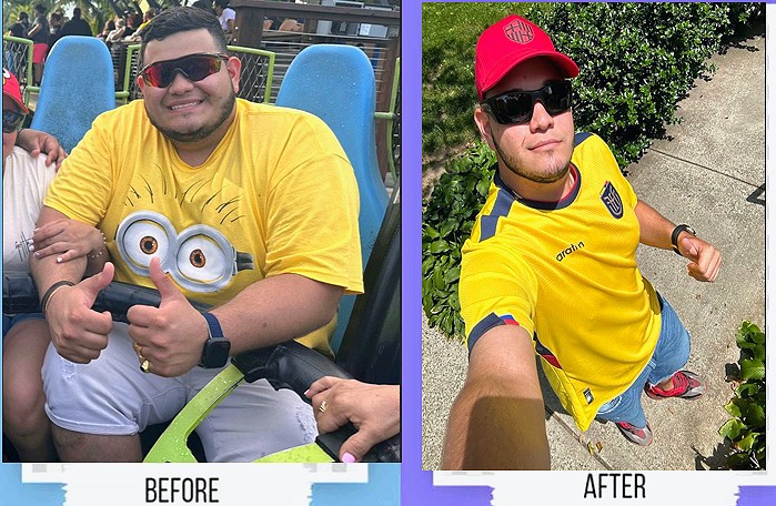 Real before and after weight loss patient result in South Florida