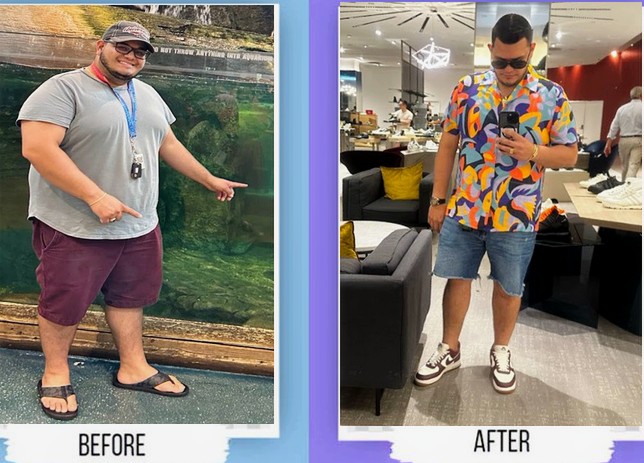 Before and after weight loss result from a real Florida patient