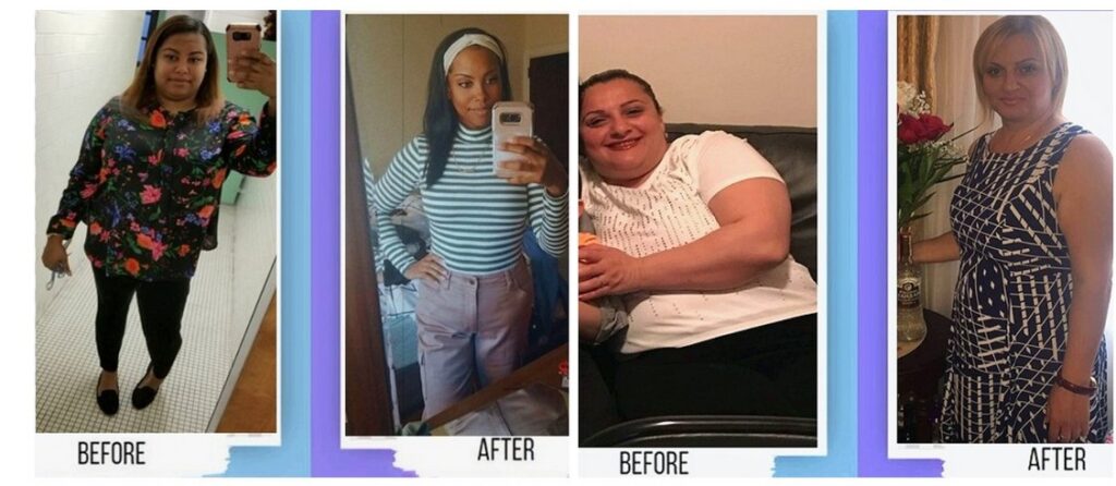 Before and after medical weight loss comparison for a patient evaluated for Mounjaro® through physician-guided telehealth care