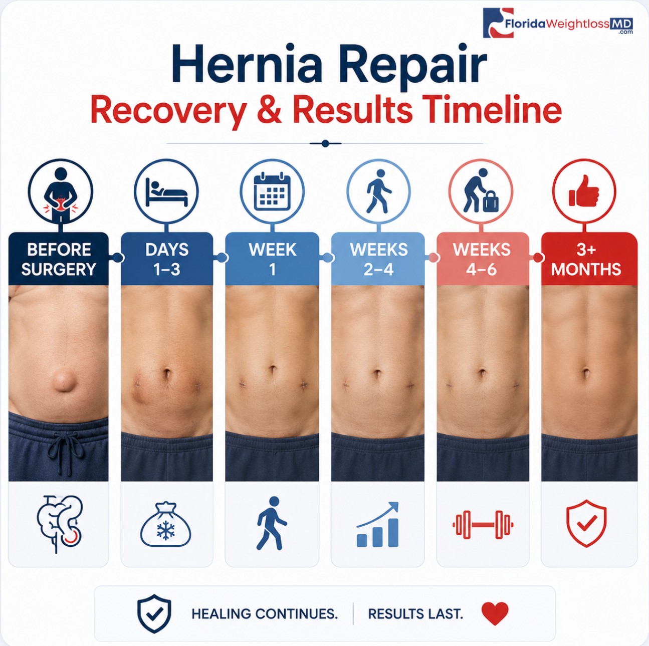 Hernia repair recovery and results timeline at Florida Surgery And Weight Loss Center