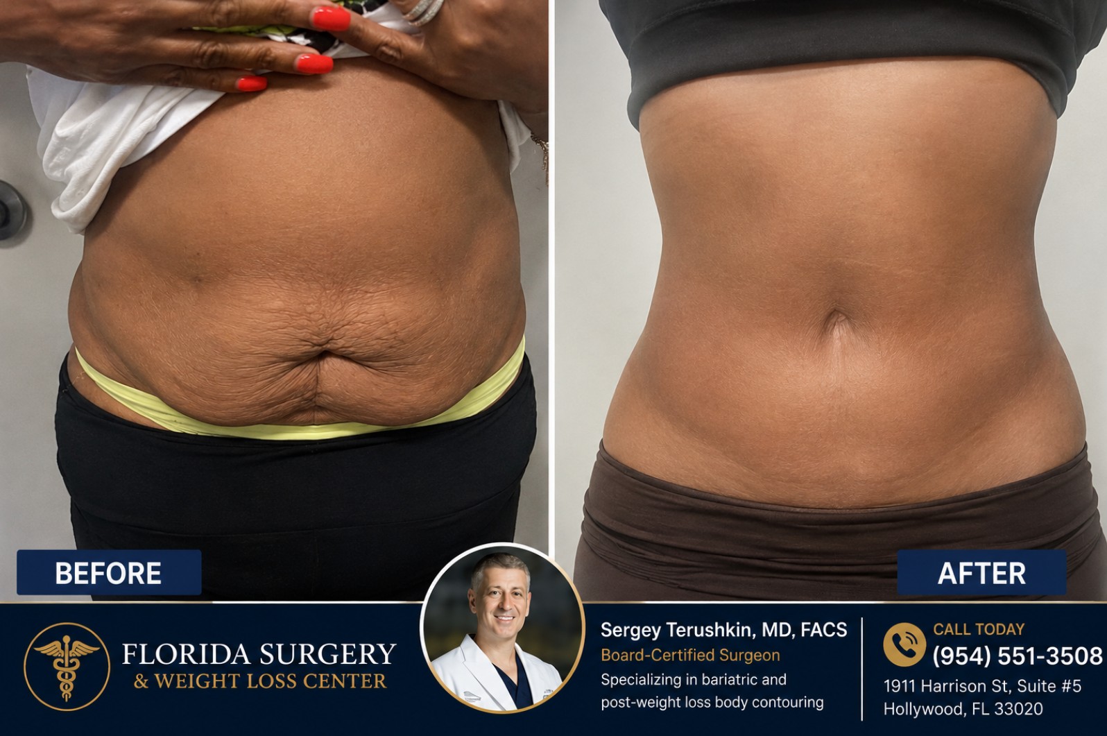 Florida Surgery And Weight Loss Center panniculectomy before and after excess skin removal results by Dr. Sergey Terushkin