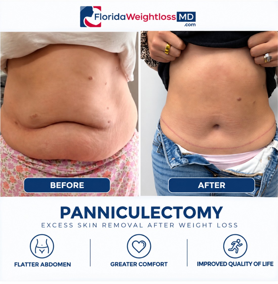Panniculectomy before and after excess abdominal skin removal after weight loss by Dr. Sergey Terushkin, MD, FACS