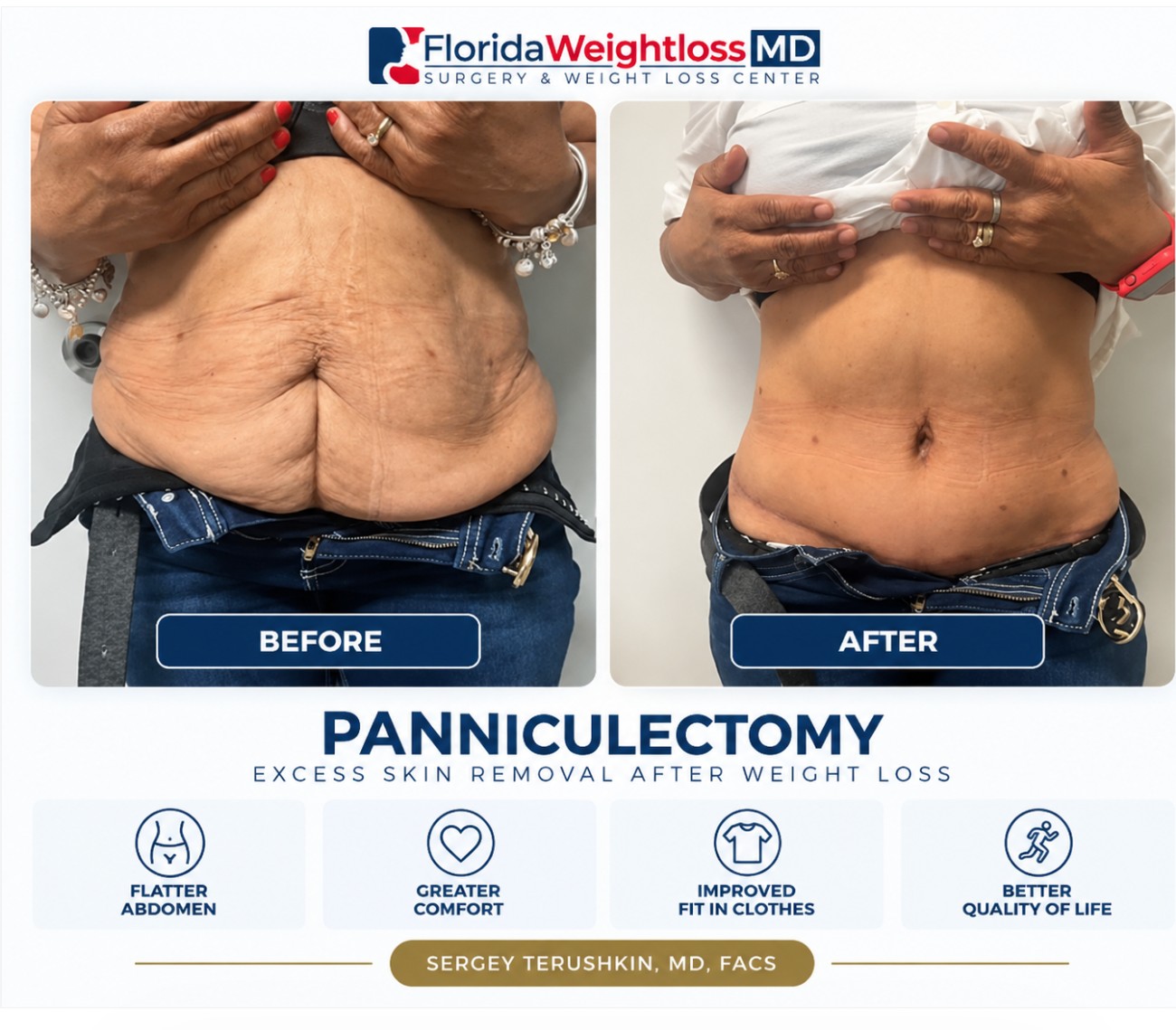 Panniculectomy before and after excess abdominal skin removal after major weight loss by Dr. Sergey Terushkin, MD, FACS
