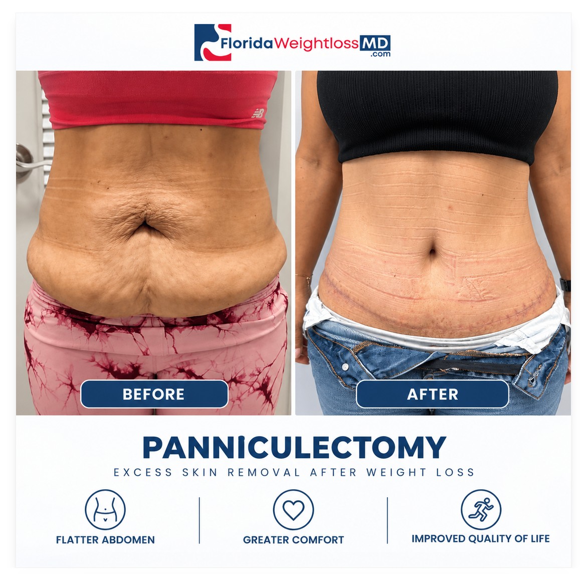 Panniculectomy before and after excess skin removal following massive weight loss by Dr. Sergey Terushkin, MD, FACS